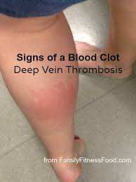calf clot dvt vein pains thrombosis