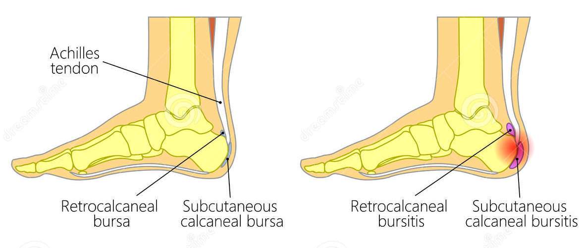 Healthy Ankle vs Bursitis Almawi Limited The Holistic Clinic