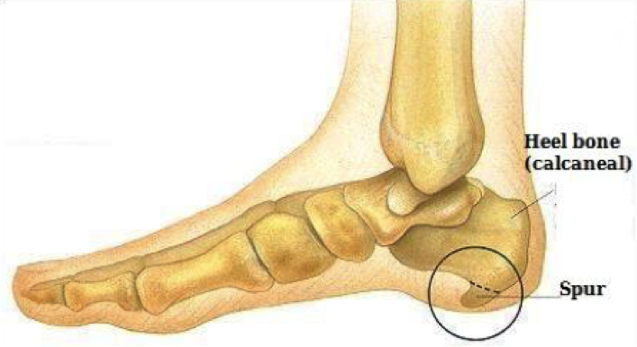 Plantar Fasciitis Vs Heel Spurs Almawi Limited The Holistic Clinic