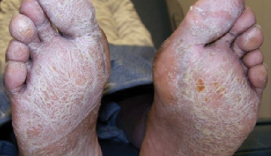 Dry Scaly Skin On Top Of Feet