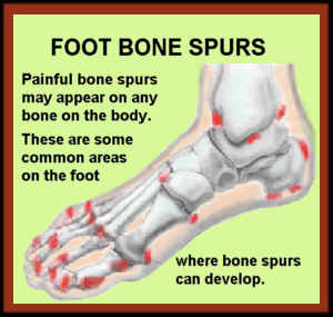 bone spur on top of foot symptoms