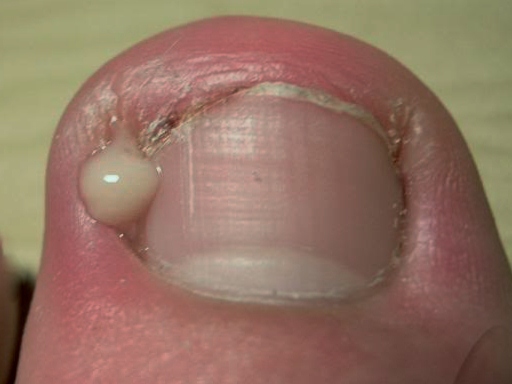 ingrown-toenail-treatment-service-feet-forward-podiatry-waikato