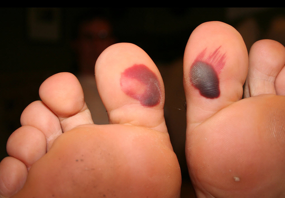 black-spot-under-toenail-melanoma-nail-ftempo