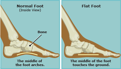 flat foot vs normal