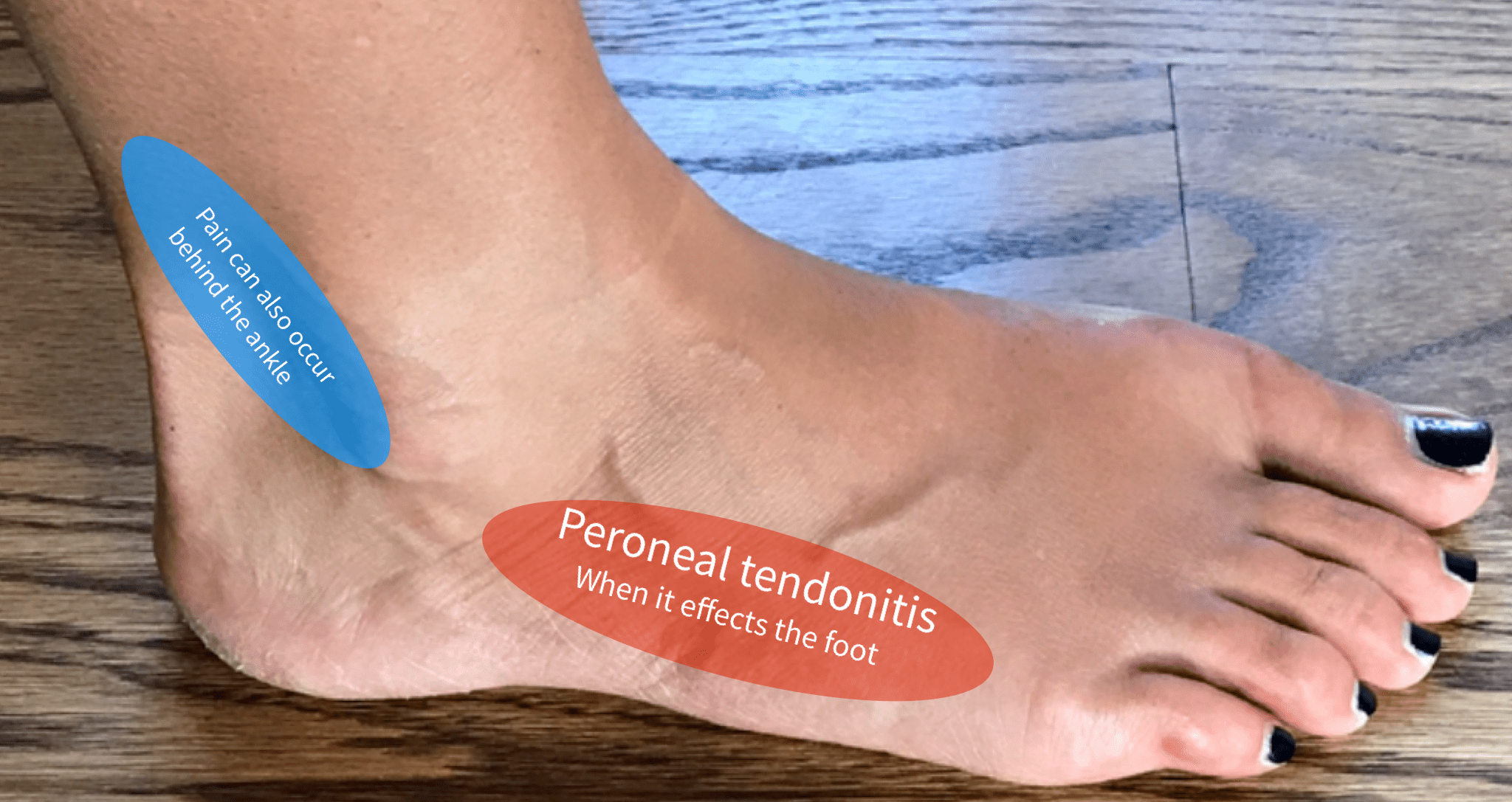 pain in outer heel of foot