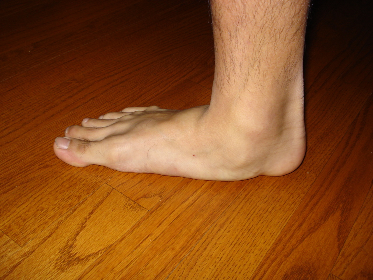 flat foot syndrome