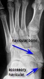 navicular accessory syndrome bone ray