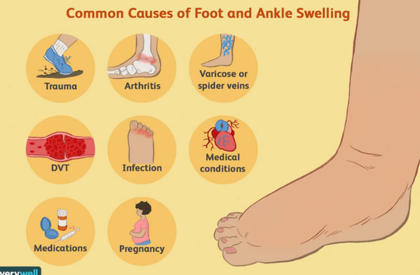 What s Causing My Feet To Swell Almawi Limited The Holistic Clinic