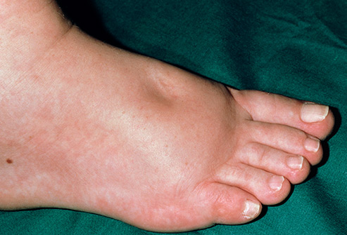 Swollen-Foot.jpg