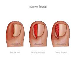 Stages of Nail Removal - Almawi Limited The Holistic Clinic